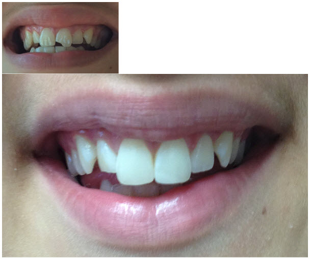 Before & After | Grace Dental